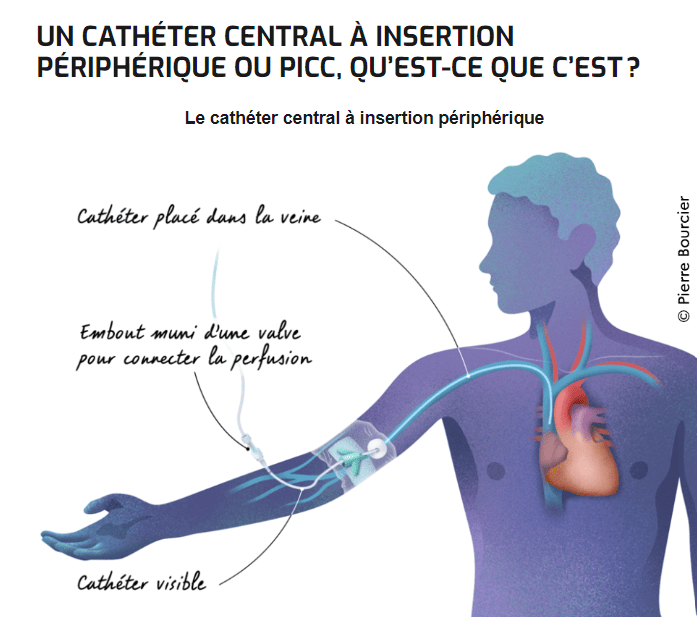 première séance de chimio