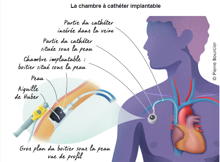 première séance de chimio